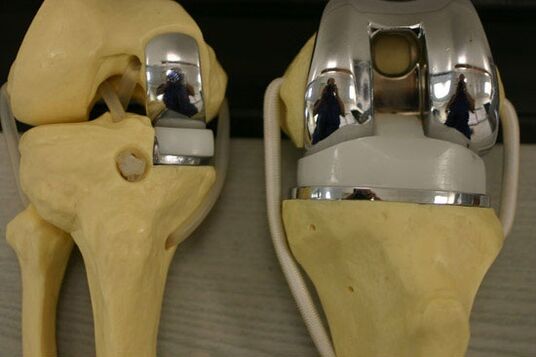 Endoprothic variants of the knee joint