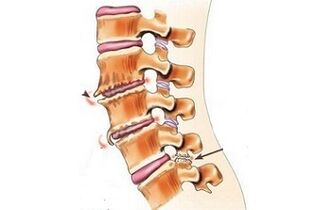 spondylartrosis as the causes of back pain