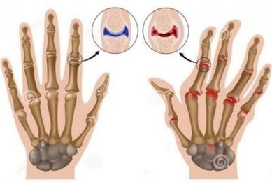 The causes of the pain in the joints of the fingers