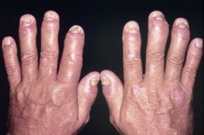 Why do the joints of the fingers hurt