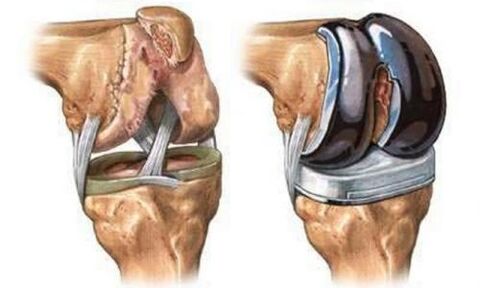 Knee's endoprothetics of arthrosis