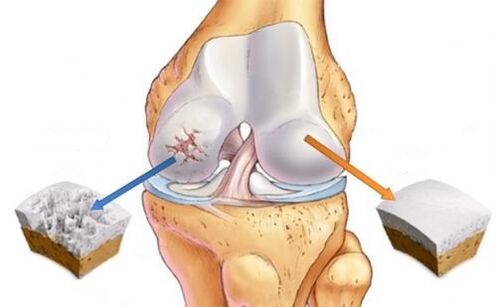 Stretch and knee arthrosis joint