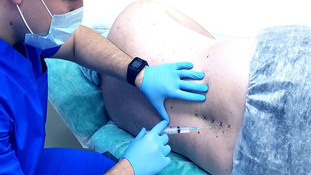 Spinal block for osteochondrosis