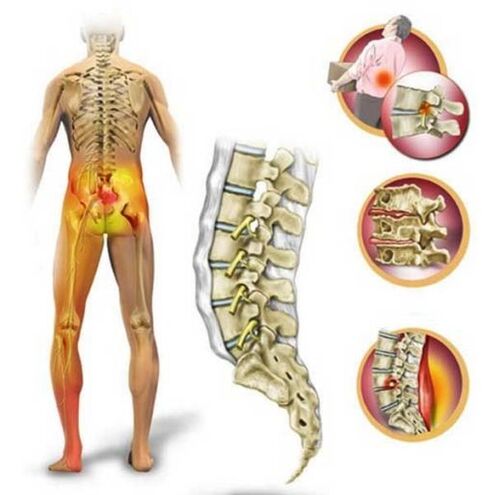 Osteochondrosis of the lumbar spine causing pain in the lower back
