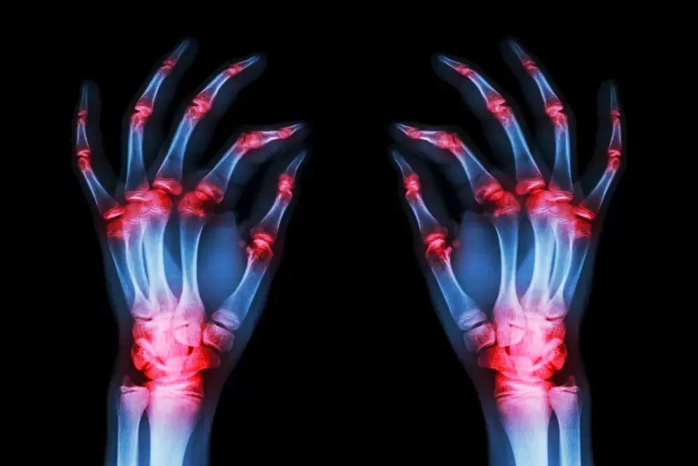 arthrosis of the finger joints