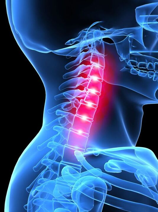 Osteochondrosis of the cervical vertebrae