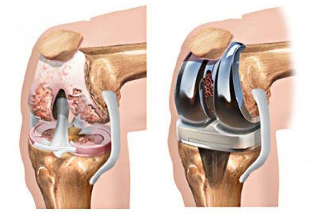 knee joint replacement in arthrosis