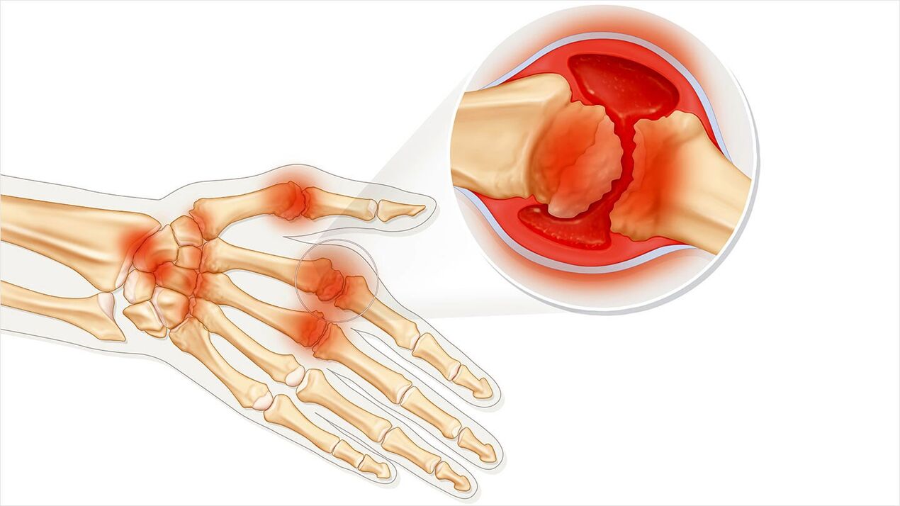 osteoarthritis for treatment with Traugel